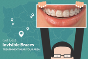 Ease and comfort of Invisible Braces in Leeds 